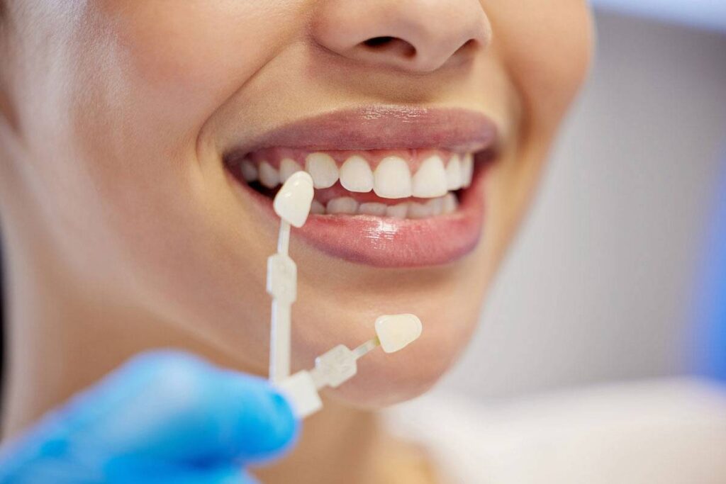 durabilitatea-fatetelor-dentare_wp