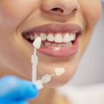 Durabilitatea fațetelor dentare: cât timp rezistă?