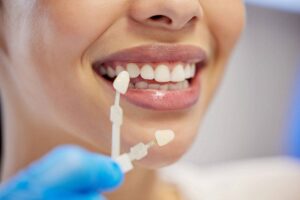 durabilitatea-fatetelor-dentare_wp