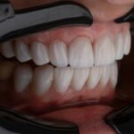Cum să ai un zâmbet natural și funcțional dacă ai avut probleme complexe cu dantura